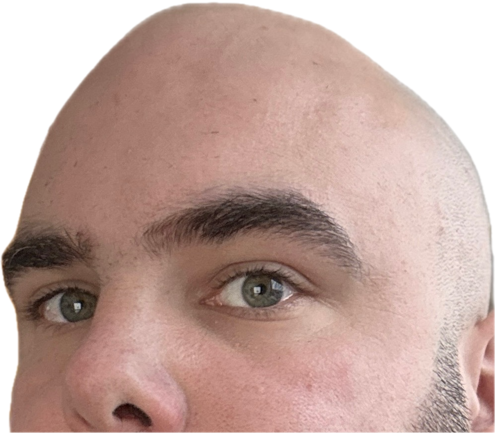 My Glorious Scalp